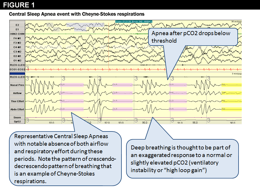 Basics of Central Sleep Apnea American College of Cardiology